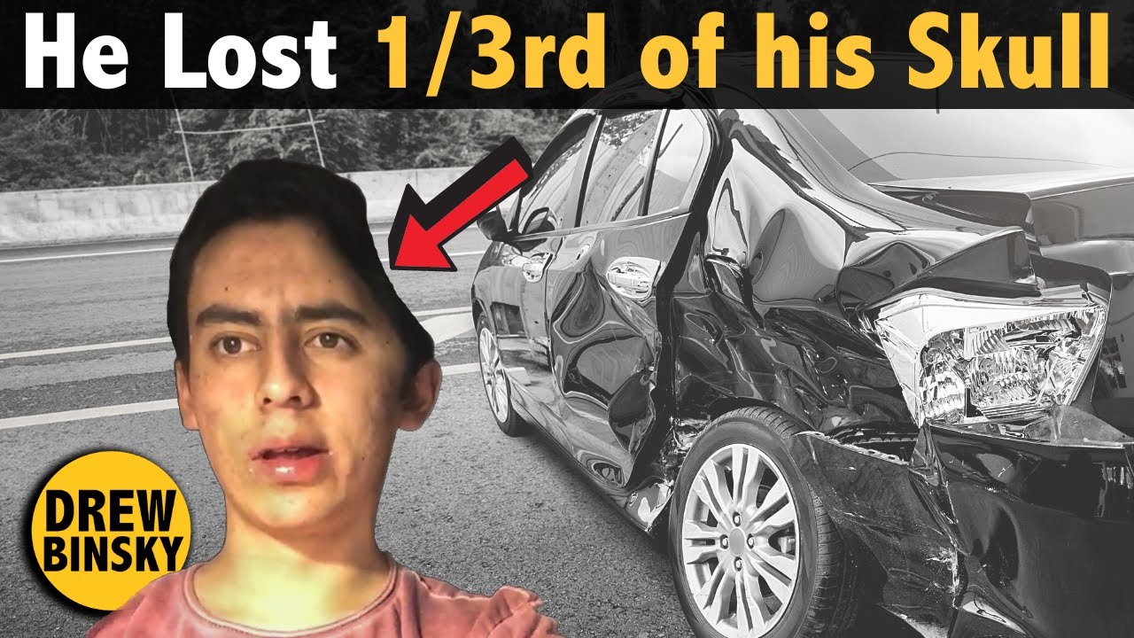 How He Lost 1/3rd of His Skull (Inspiring Story) 22 hq720 722